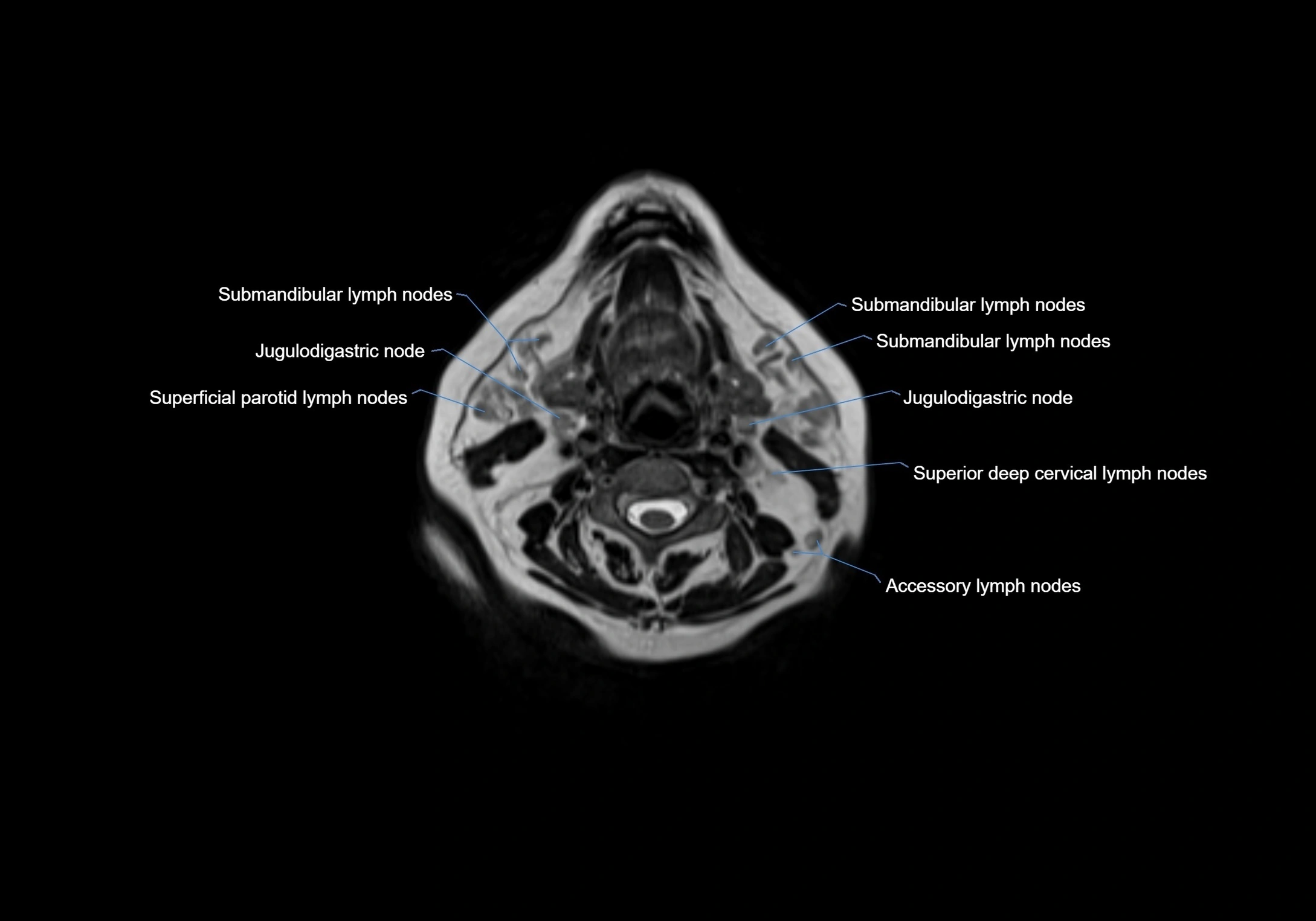 Neck axial  lymph node cross sectional MRI anatomy 3T MRI  image-img-00001-00051.webp